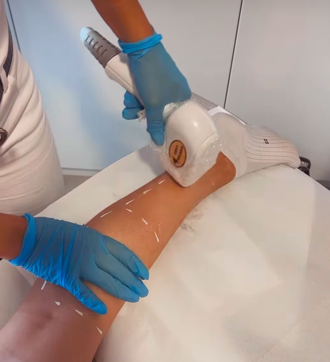 Trattamento laser di depilazione